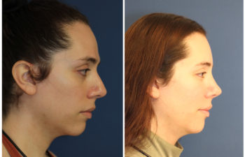 Girl before and after cheek implant
