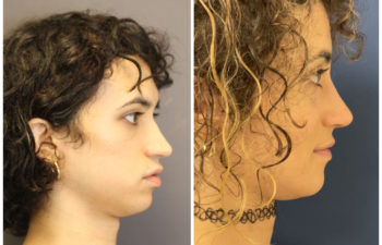 Girl before and after cheek implant