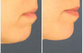 woman before and after chin implant procedure