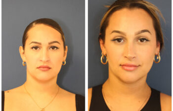 Female patient before and after rhinoplasty surgery