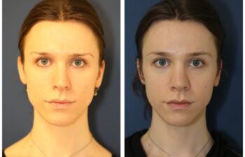 Patient before and after rhinoplasty and facial feminization