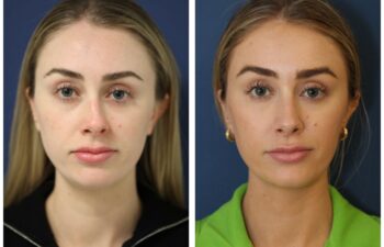 Patient before and after rhinoplasty
