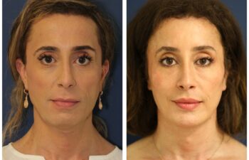 Patient before and after facial feminization