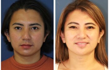 Patient before and after facial feminization