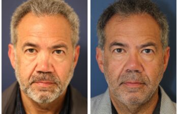 Patient before and after revision rhinoplasty