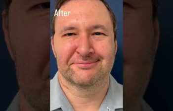 Nerve Transfers + Cross Face Nerve Graft After Acoustic Neuroma Surgery