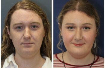 Patient before and after rhinoplasty