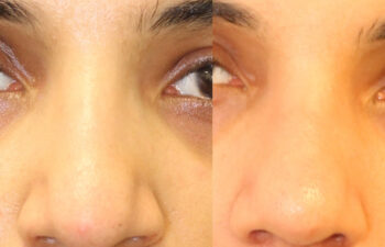 Patient before and after rhinoplasty