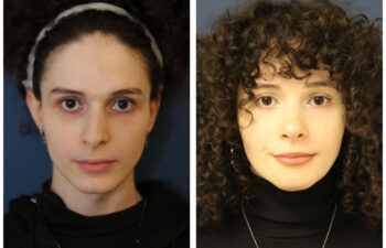 Patient before and after rhinoplasty
