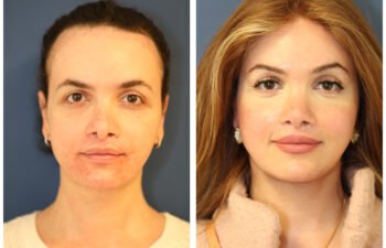 Patient before and after rhinoplasty with rib cartilage graft