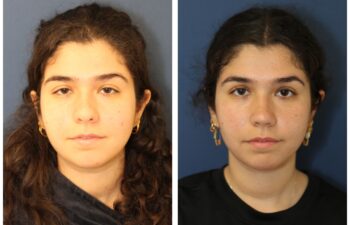 Patient before and after rhinoplasty