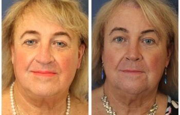 Patient before and after rhinoplasty