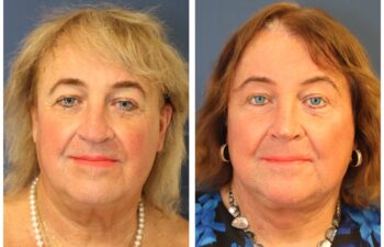 Patient before and after facial feminization