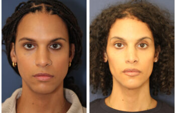 patient before and after facial feminization