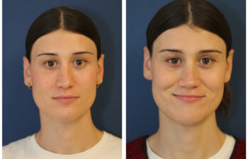 patient before and after Revision Rhinoplasty with Rib Cartilage Graft