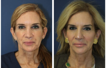 patient before and after Revision Rhinoplasty with Rib Cartilage Graft