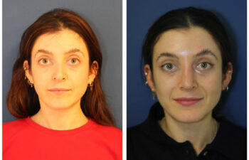 patient before and after Revision Rhinoplasty with Rib Cartilage Graft