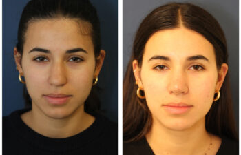 patient before and after closed rhinoplasty