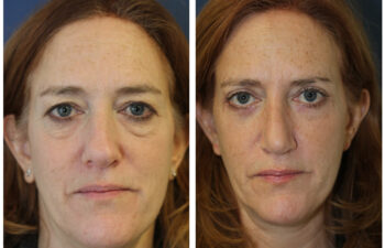 patient before and after Upper and Lower Eyelid Blepharoplasty