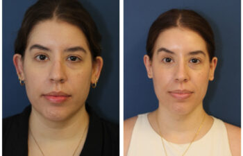 patient before and after otoplasty