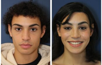 patient before and after facial feminization