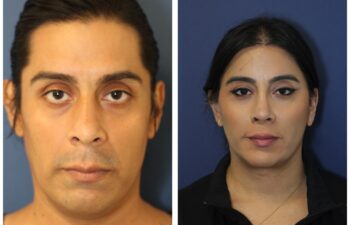 patient before and after facial feminization