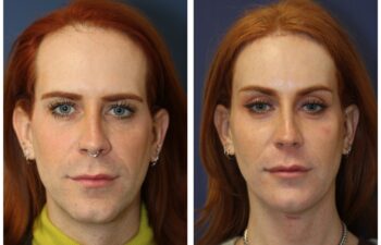 patient before and after facial feminization
