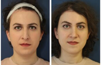 patient before and after facial feminization