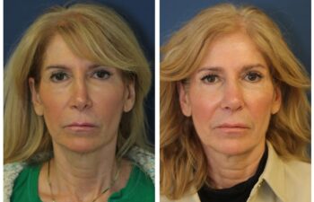 patient before and after Revision Rhinoplasty with Rib Cartilage Graft