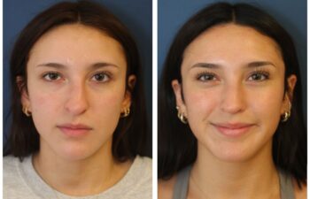patient before and after open rhinoplasty