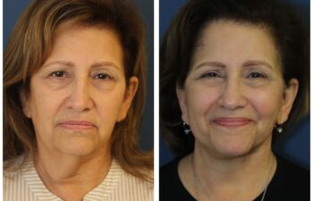patient before and after face and neck lift, front view