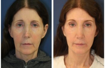patient before and after face and neck lift, front view