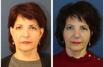 patient before and after Revision Rhinoplasty with Rib Cartilage Graft, front view