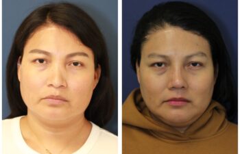 patient before and after Revision Rhinoplasty with Diced Cartilage Fascia Graft, front view