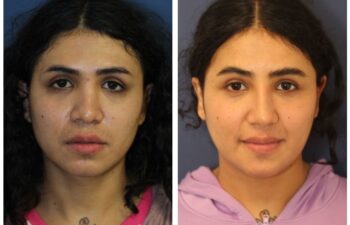 patient before and after Revision Rhinoplasty with Diced Cartilage Fascia Graft, front view