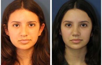 patient before and after Open Rhinoplasty, front view