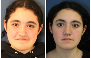patient before and after Open Rhinoplasty with Diced Cartilage Fascia Graft, front view