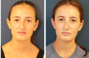 patient before and after open rhinoplasty, front view