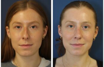 patient before and after closed rhinoplasty, front view