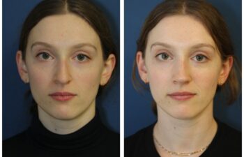 patient before and after closed rhinoplasty, front view